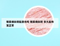 银屑病白斑能激光吗 银屑病白斑 多久能恢复正常