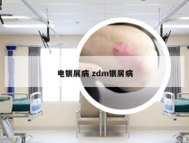 电银屑病 zdm银屑病