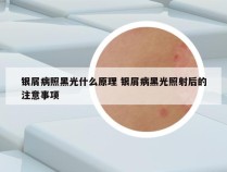 银屑病照黑光什么原理 银屑病黑光照射后的注意事项