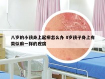 八岁的小孩身上起癣怎么办 8岁孩子身上有类似癣一样的疙瘩