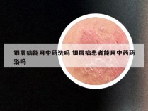 银屑病能用中药洗吗 银屑病患者能用中药药浴吗