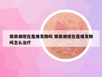 银屑病现在是爆发期吗 银屑病现在是爆发期吗怎么治疗