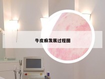 牛皮癣发展过程图