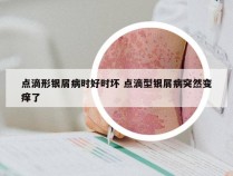 点滴形银屑病时好时坏 点滴型银屑病突然变痒了