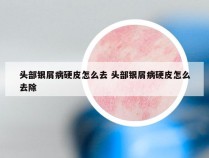 头部银屑病硬皮怎么去 头部银屑病硬皮怎么去除