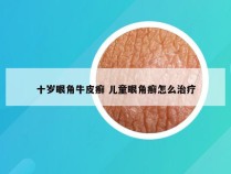 十岁眼角牛皮癣 儿童眼角癣怎么治疗