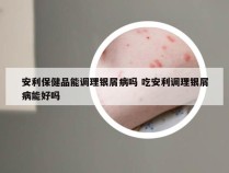 安利保健品能调理银屑病吗 吃安利调理银屑病能好吗