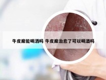 牛皮廨能喝洒吗 牛皮廨治愈了可以喝酒吗