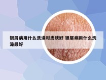 银屑病用什么洗澡对皮肤好 银屑病用什么洗澡最好