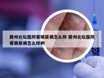 滕州北坛医院看银屑病怎么样 滕州北坛医院看银屑病怎么样啊