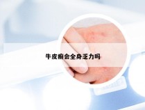 牛皮癣会全身乏力吗