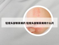 轻度头部银屑病药 轻度头部银屑病用什么药