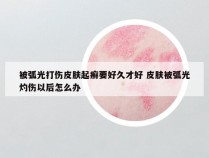 被弧光打伤皮肤起癣要好久才好 皮肤被弧光灼伤以后怎么办