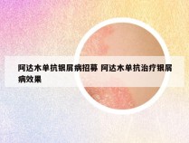 阿达木单抗银屑病招募 阿达木单抗治疗银屑病效果