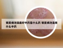 银屑病泡澡最好中药是什么药 银屑病泡澡用什么中药