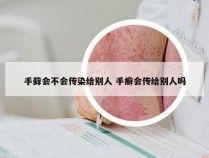 手藓会不会传染给别人 手癣会传给别人吗