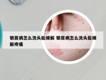 银屑病怎么洗头能缓解 银屑病怎么洗头能缓解疼痛