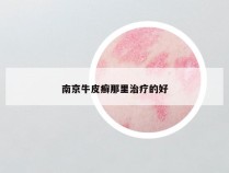 南京牛皮癣那里治疗的好