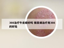 308治疗牛皮癣好吗 银屑病治疗用308的好处