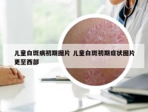 儿童白斑病初期图片 儿童白斑初期症状图片更至西部