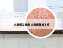 大腿根上长癣 大腿根部长了癣