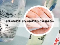 卡泊三醇药膏 卡泊三醇药膏治疗银屑病怎么样