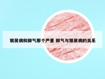 银屑病和脚气那个严重 脚气与银屑病的关系