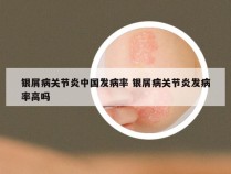 银屑病关节炎中国发病率 银屑病关节炎发病率高吗