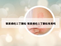 银屑病吃二丁颗粒 银屑病吃二丁颗粒有用吗