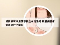 银屑病可以用艾草和盐水泡澡吗 银屑病患者能用艾叶泡澡吗