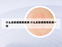 什么皮肤病像银屑病 什么皮肤病像银屑病一样