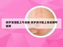 四岁宝宝脸上牛皮癣 四岁孩子脸上有皮癣咋回事