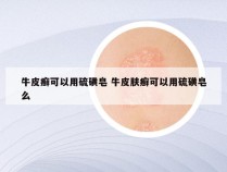 牛皮癣可以用硫磺皂 牛皮肤癣可以用硫磺皂么