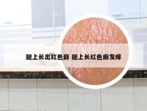 腿上长出红色藓 腿上长红色癣发痒