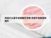 淘宝什么是牛皮癣图片早期 淘宝牛皮鲜症状图片