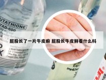 屁股长了一片牛皮癣 屁股长牛皮鲜看什么科