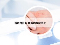 指藓是什么 指癣的症状图片