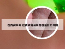 在西藏长癣 在西藏容易长痘痘是什么原因