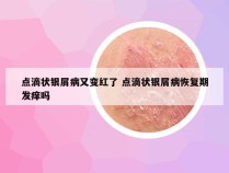 点滴状银屑病又变红了 点滴状银屑病恢复期发痒吗