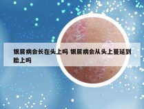 银屑病会长在头上吗 银屑病会从头上蔓延到脸上吗