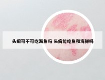 头癣可不可吃海鱼吗 头癣能吃鱼和海鲜吗