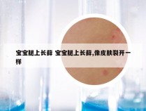 宝宝腿上长藓 宝宝腿上长藓,像皮肤裂开一样