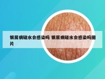 银屑病碰水会感染吗 银屑病碰水会感染吗图片