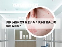 周岁小孩头皮生癣怎么办 1岁多宝宝头上有癣怎么治疗?