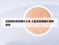 皮肤癣的症状图片小孩 儿童皮肤癣图片初期症状