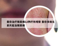 善存治疗银屑病12例疗效观察 善存多维元素片能治银屑病