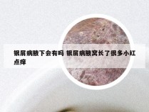 银屑病腋下会有吗 银屑病腋窝长了很多小红点痒