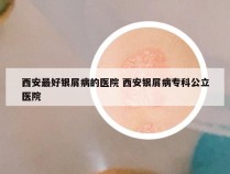 西安最好银屑病的医院 西安银屑病专科公立医院