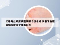 长春专业银屑病医院哪个技术好 长春专业银屑病医院哪个技术好点