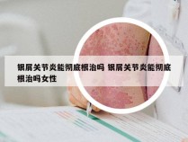 银屑关节炎能彻底根治吗 银屑关节炎能彻底根治吗女性